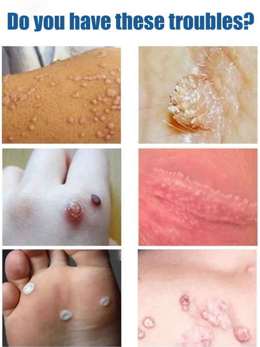 Painless ᴡᴀʀᴛ removal pen – Home skincare solution